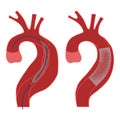 aortic aneurysm. Aortic stenting. Royalty Free Stock Photo